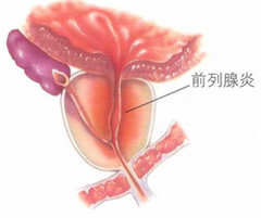阳江怎么治好前列腺炎