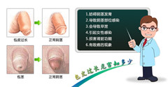 阳江为什么要做包皮手术