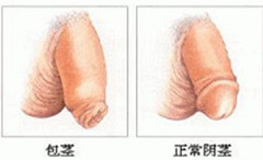 包茎容易带来哪些疾病隐患
